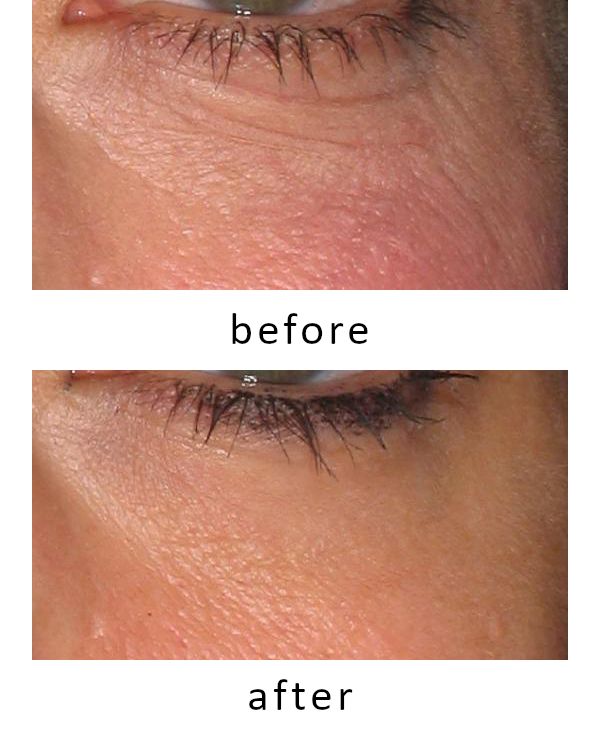 Silkn FaceTite Revive Cordless